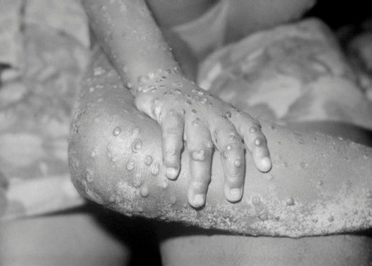 Deadly "monkeypox" virus diagnosed in England for first ...